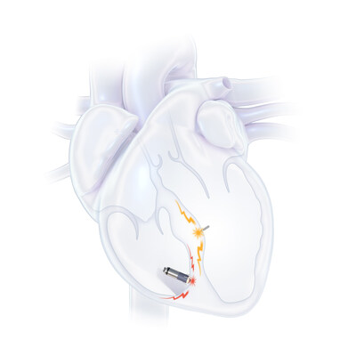 First Commercial Implants of WiSE System...
